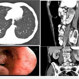 Pdf Isolated Renal Metastasis From Primary Lung Squamous Cell