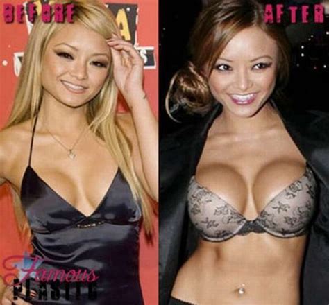 Breast Implants Pictures