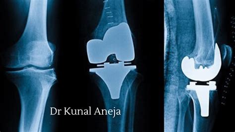 Best Knee Replacement Surgeon In Delhi Dr Kunal Aneja