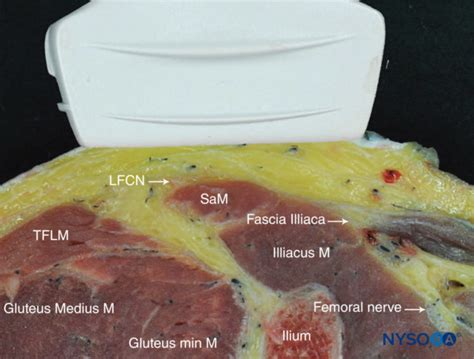 Bloc du nerf cutané fémoral latéral guidé par ultrasons NYSORA