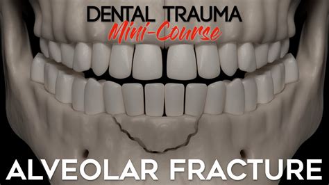 Dental Trauma Mini Course Part 11 Dental Trauma Guide Alveolar