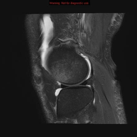 Transient Lateral Patellar Dislocation Image Radiopaedia Org