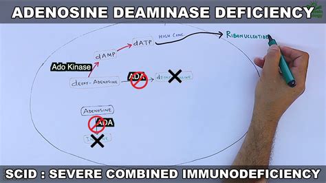 Adenosine Deaminase Deficiency Scid Youtube