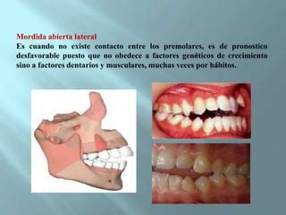 Mordida Abierta Ppt