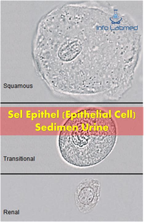 Sel Epithel (Epithelial Cell) Sedimen Urine - Seri Edukasi Teknologi ...