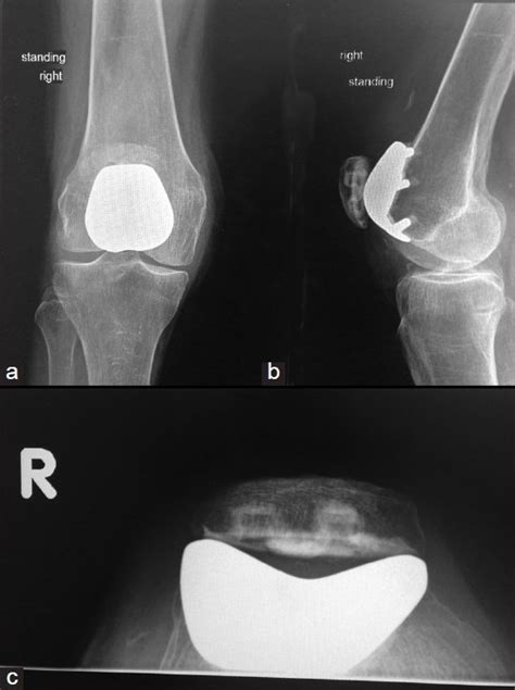 Postoperative Anteroposterior Radiograph A Lateral Radiograph B And Download Scientific