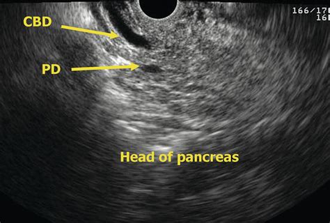 Eus Of The Normal Pancreas Radiology Key