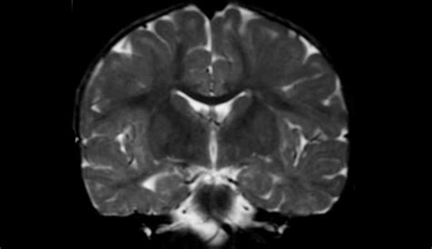 Megalencephaly