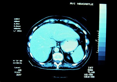 Ct Scan Of Normal Liver Photograph By Simon Fraserscience Photo