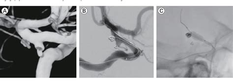 Figure 2 From Acute Frame Coil Migration During Filling Coil Retrieval