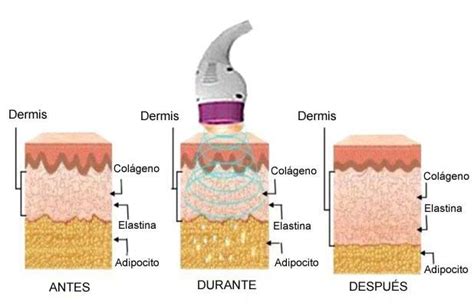 Radiofrecuencia Facial Y Corporal En Casa Cuida Tu Piel