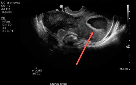 Ultrasound Of The Month No Definitive Yolk Sac No Definitive Iup