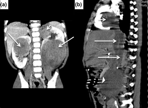 Understanding The Principles In Management Of Wilms Tumour Can