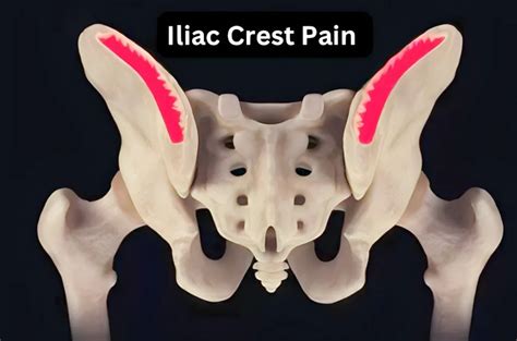 Iliac Crest Pain: Relieve Iliac Crest Pain 2024!