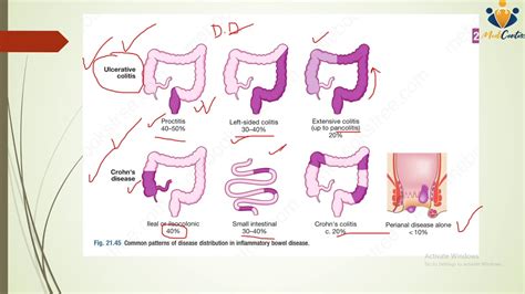 Pathophysiology Of Ulcerative Colitis