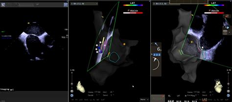 Intracardiac Echocardiography Ice Was Performed To Confirm The