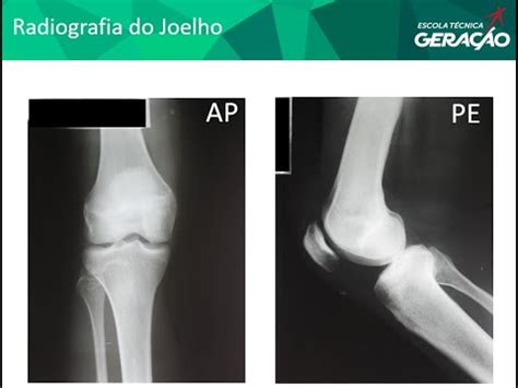 Radiografia Do Joelho AP Perfil YouTube