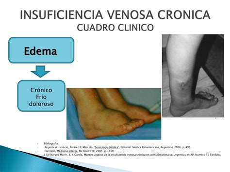 Ppt Insuficiencia Arterial Y Venosa Powerpoint Presentation Free