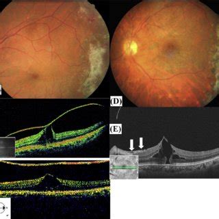 Case A Fundus Photography Shows That The Fvp Is Located Mainly On