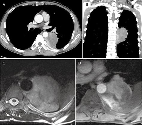 Primary Nonseminomatous Germ Cell Tumor In The Posterior Mediastinum