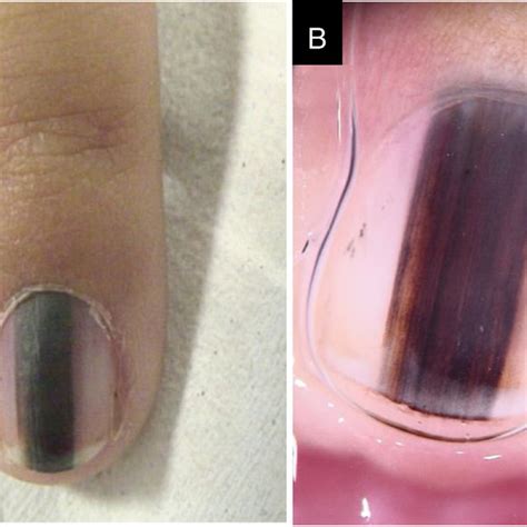 A-Muehrcke's lines shown in the fingernails of both hands; B-Muehrcke's... | Download Scientific ...