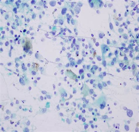 Pathology Outlines Oral Mucosal Melanoma