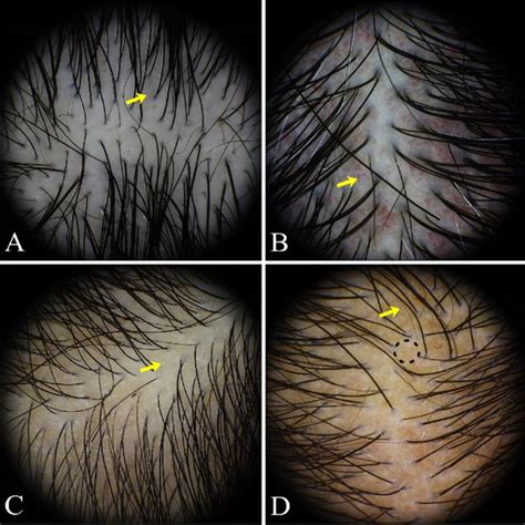 Trichoscopic Findings Of Normal Subjects A Simple Red Loops Yellow Download Scientific