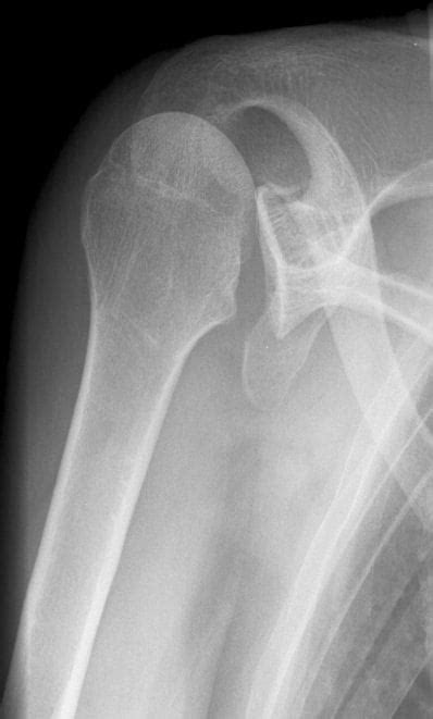 Posterior Shoulder Dislocation Mechanism