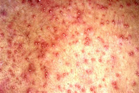 Heat Rash Pictures And How To Get Rid Of It