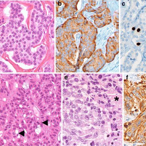 Histology of well-differentiated neuroendocrine cancer. a-c) Low grade... | Download Scientific ...