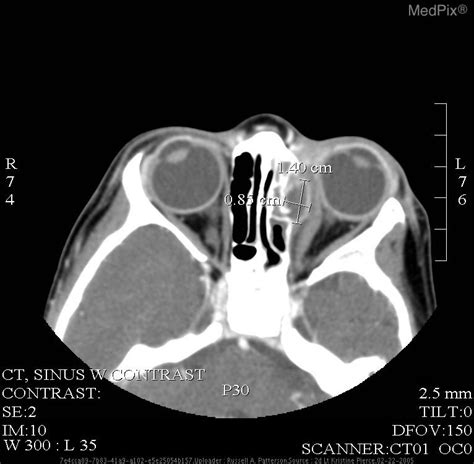 Subperiosteal Abscess