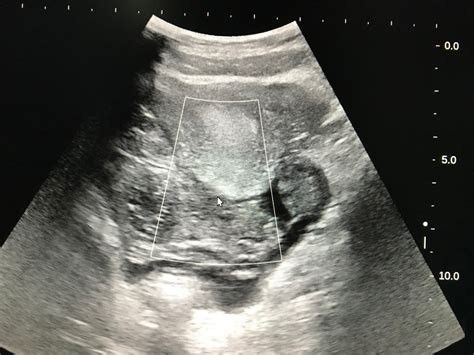 VIETNAMESE MEDIC ULTRASOUND: CASE 510: MITTELSCHMERZ SYNDROME, Dr PHAN THANH HẢI, MEDIC MEDICAL ...