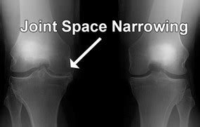 Knee Joint Space