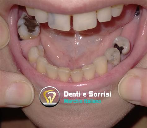 Quello Che Devi Sapere Sulle Cure Dentali In Albania A Tirana