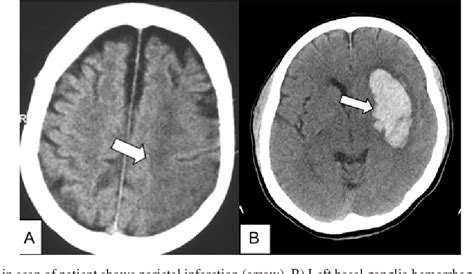 Stroke Ct Scan