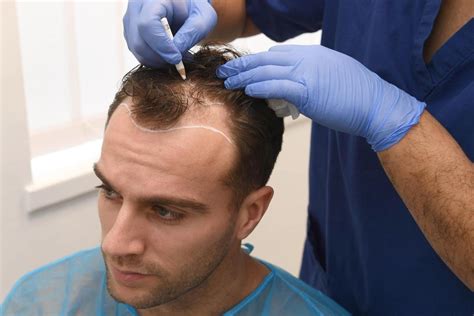 10 Best Hair Transplant Clinics In Turkey In 2022