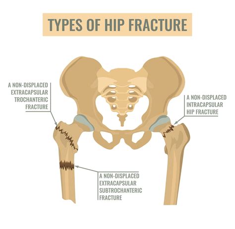 Hip Fracture Types Surgery To Repair A Hip Fracture: Learning About