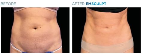 Emsculpt Build Muscle And Burn Fat Fast Nusculpt