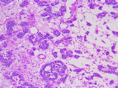 Human gastrointestinal Carcinoid tumor H&E 10x Tissue Types, Tumor ...