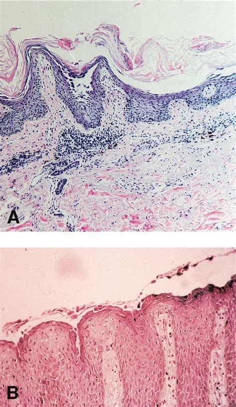 Light Microscopy A Histologic Study Of A Papulosquamous Lesion