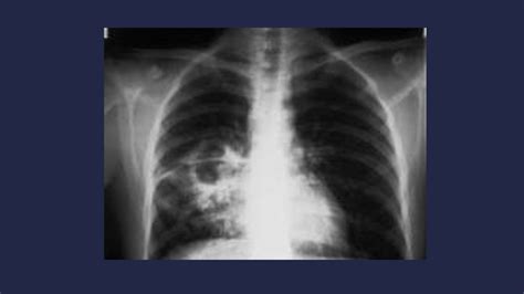 Tuberculosis Pulmonar En La Radiografía De Tórax