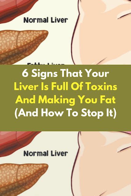 6 Signs That Your Liver Is Full Of Toxins And Making You Fat And How