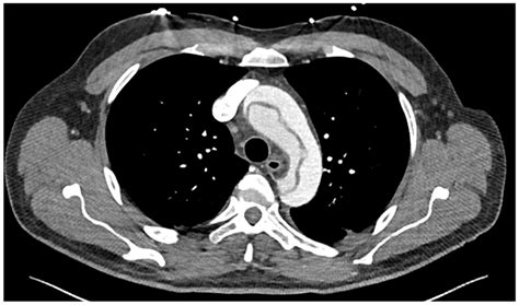 Ct Of The Aorta Cross Sectional View Of The Aortic Arch Showing The