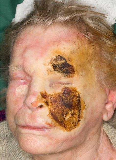 Second Degree Burns On Face