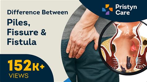 Difference Between Piles Fissure And Fistula Call Now 9821388242