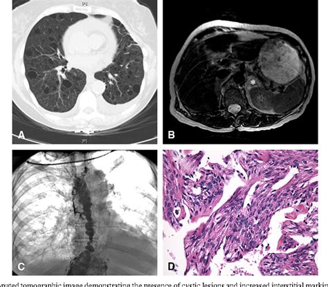 Figure 1 From Treatment Of Refractory Lymphangioleiomyomatosis