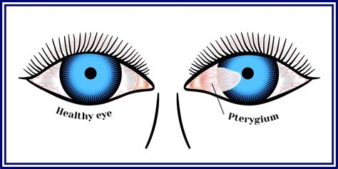 Pterygium Eye Treatment - Woolfson Eye Institute