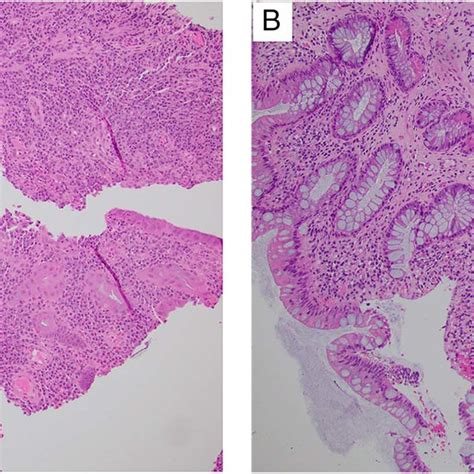 A Initial Colonic Biopsy Demonstrating Active Chronic Colitis With Download Scientific