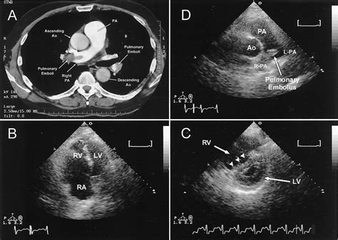 Acute Pulmonary Embolism Circulation