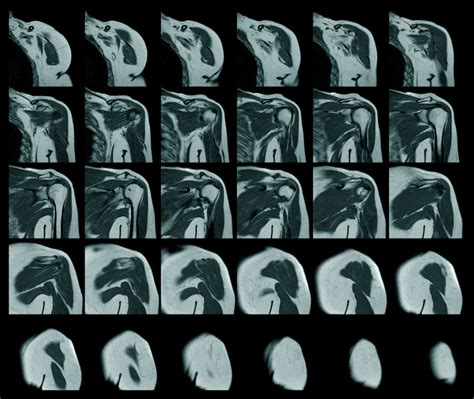Magnetic Resonance Imaging Of Left Shoulder Rotator Cuff Tear Wi